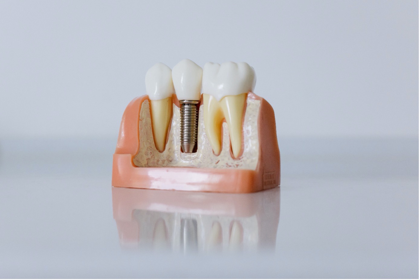 Prothèse Dentaire: Guide Pratique Complet 2023