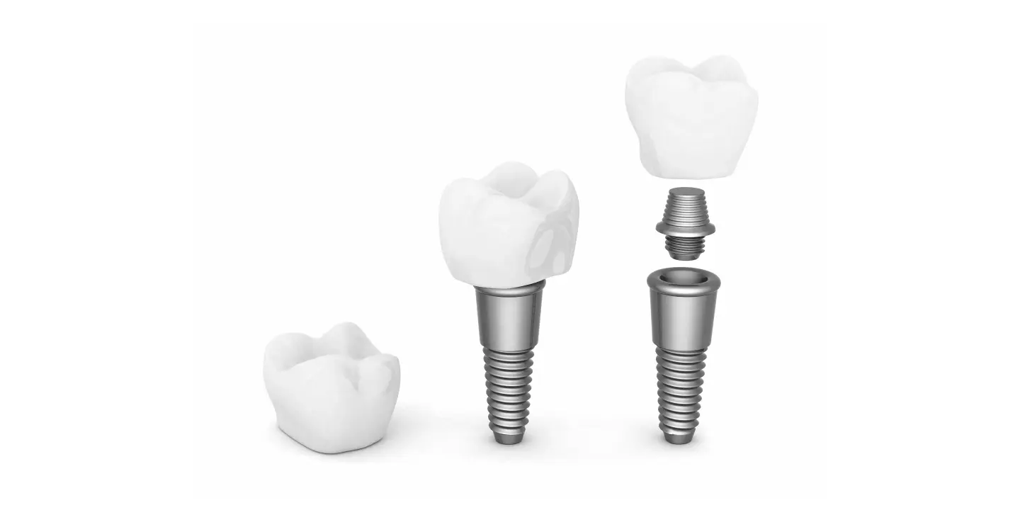 remboursement implants dentaires